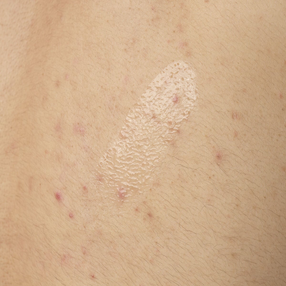 salicylic-acid-0-5-body-serum-r9 ORD-salicylic-acid-05-body-240ml-application.jpg