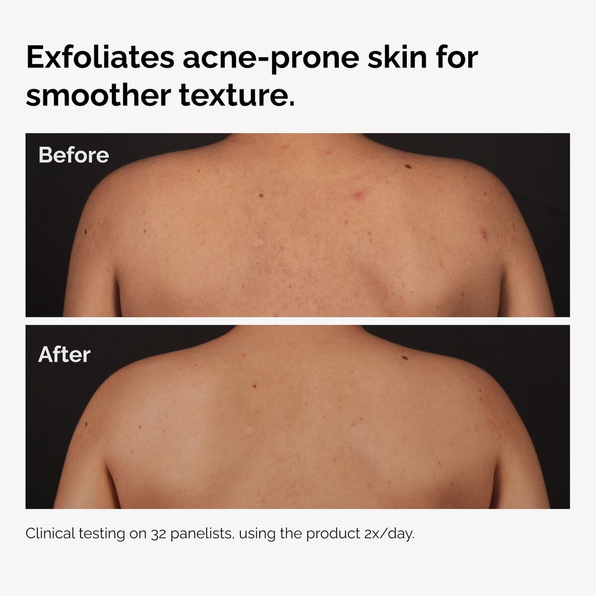 salicylic-acid-0-5-body-serum-r9 ord-salicylic-acid-body-serum-before-after-graphic-NA.jpg