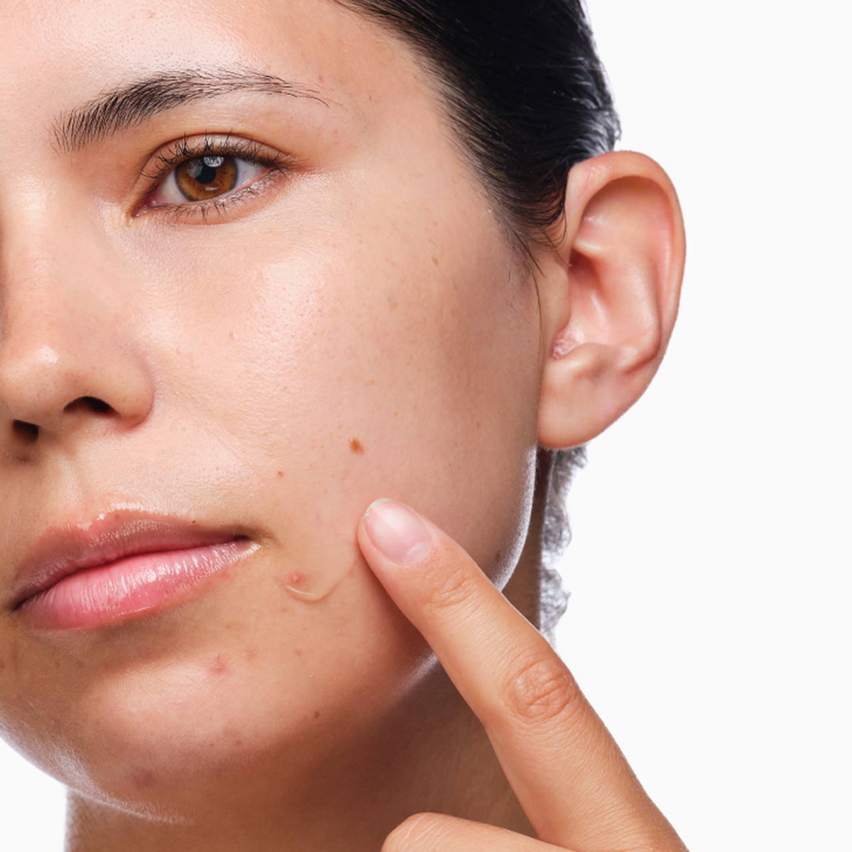 the-acne-set-v6 rdn-the-acne-set-application.png